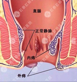 男性痔疮怎么检查较？