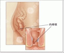 治疗内痔疼痛大不大