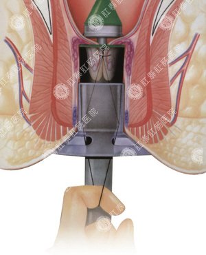 福州肛肠医院