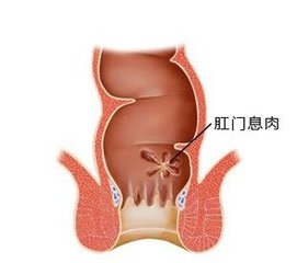 福州肛肠息肉专科