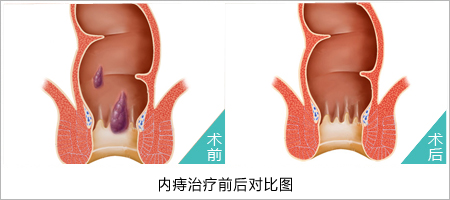 福州肛肠医院 福州医博肛肠医院 福州看痔疮的医院 福州肛瘘医院 福州肛裂医院 福州肠炎医院