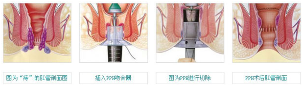 福州肛肠医院